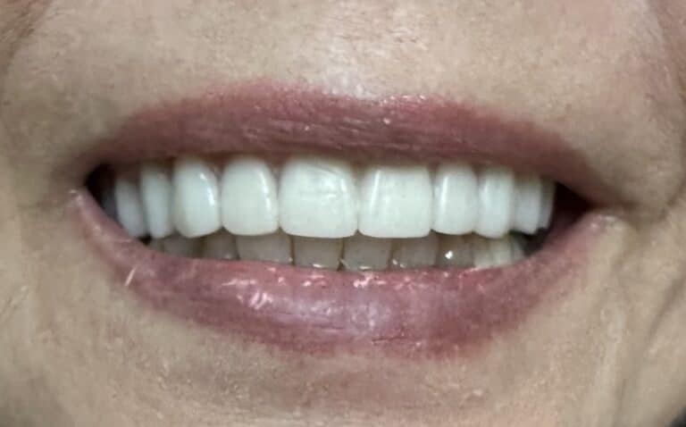 After Image: Upper Full-Arch Fixed Screw-Retained Hybrid Implant Prosthesis - front