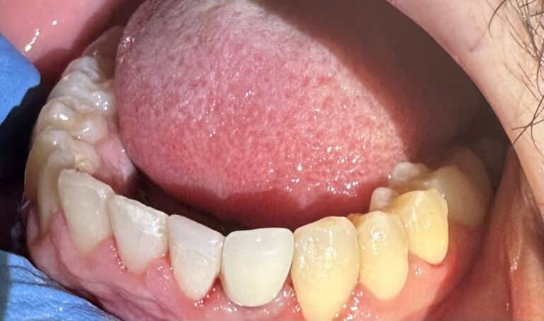 After Image: *Graphic Images* Bone Graft Harvesting and Transplantation from Lower Jaw with Single Implant Placement - front