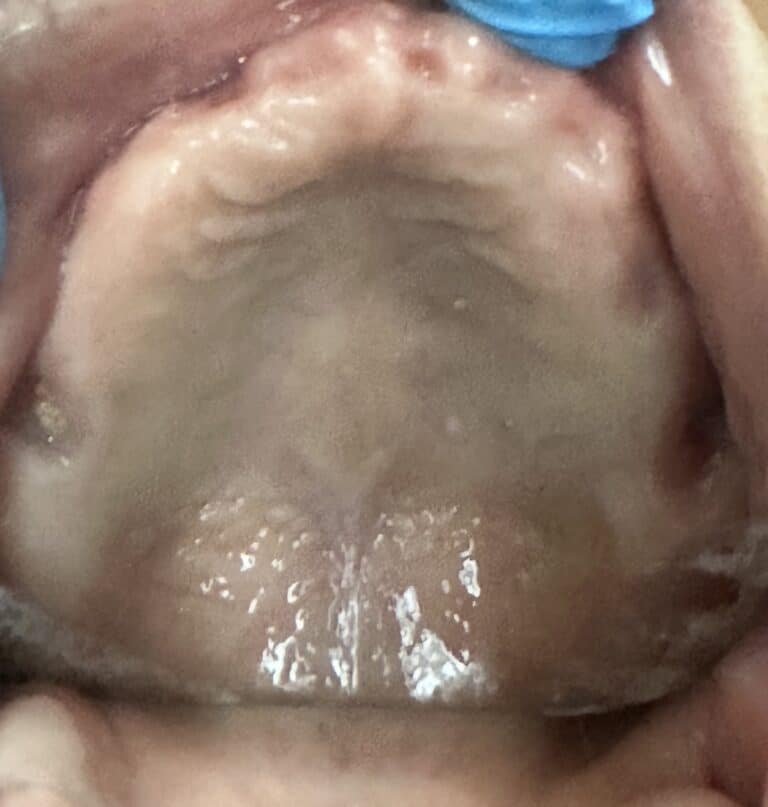 Before Image: Full Mouth Upper and Lower Fixed Screw-Retained Implant Prostheses - front