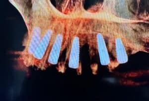 After Image: Extraction of Upper Teeth with Immediate Placement of Implants for an “All-on-6” Full-Arch Fixed Implant Prosthesis
