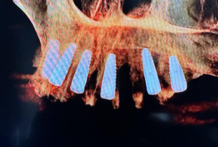 After Image: Extraction of Upper Teeth with Immediate Placement of Implants for an “All-on-6” Full-Arch Fixed Implant Prosthesis - front