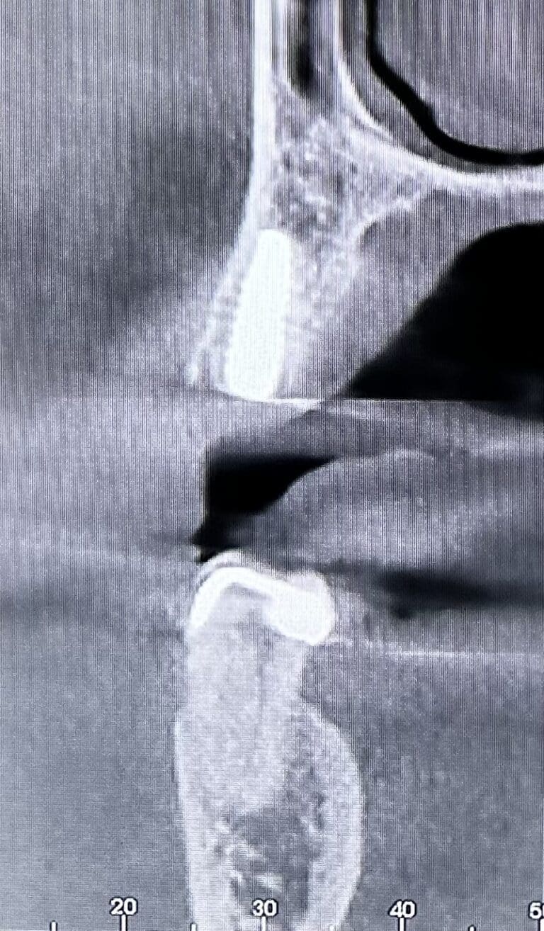 After Image: Extraction of Upper Teeth with Immediate Placement of Implants for an “All-on-6” Full-Arch Fixed Implant Prosthesis - front