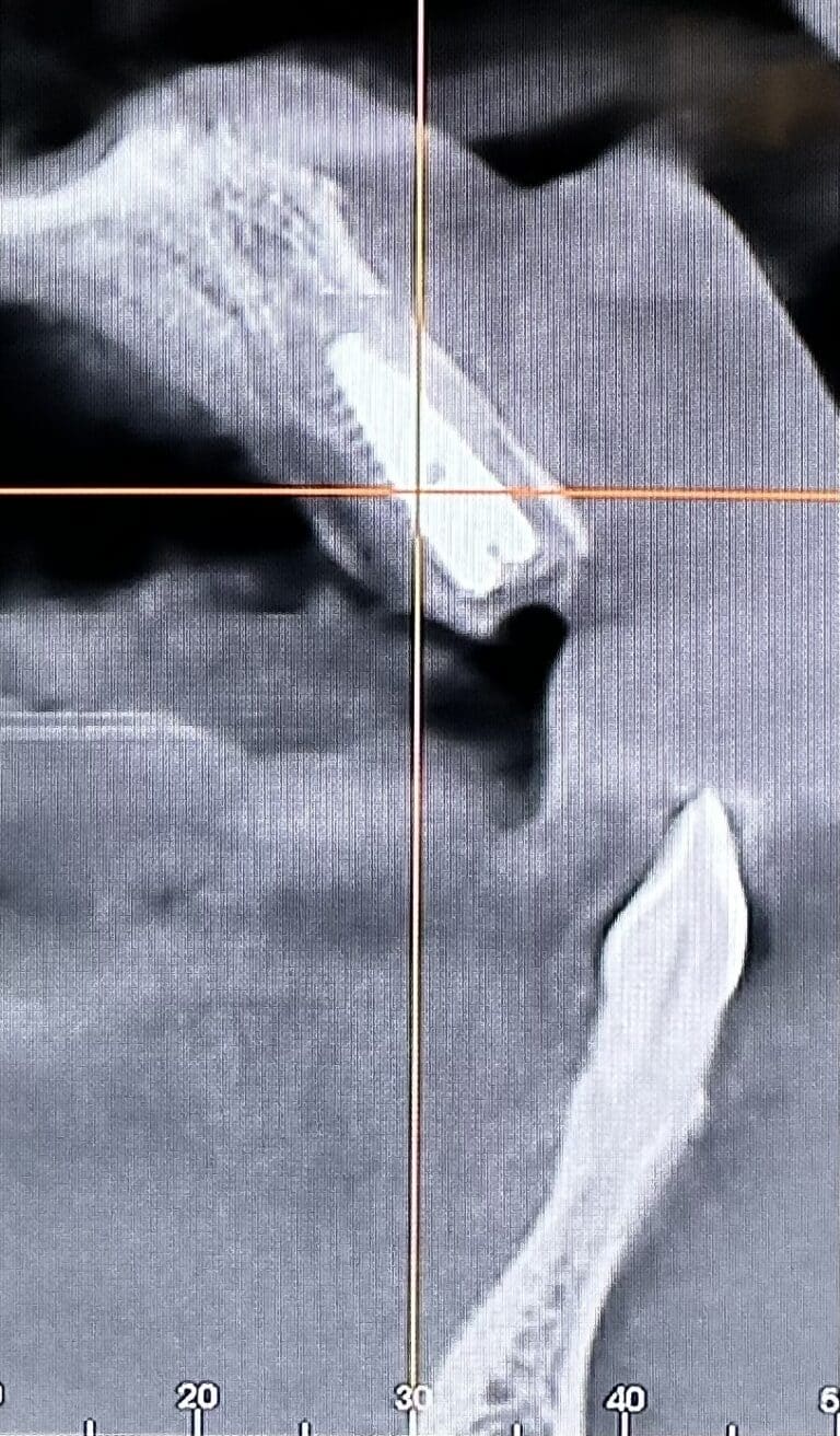 After Image: Extraction of Upper Teeth with Immediate Placement of Implants for an “All-on-6” Full-Arch Fixed Implant Prosthesis - front