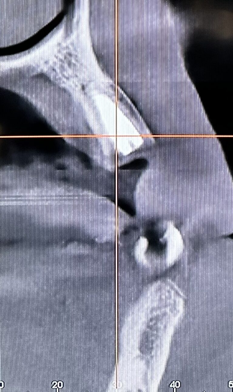 After Image: Extraction of Upper Teeth with Immediate Placement of Implants for an “All-on-6” Full-Arch Fixed Implant Prosthesis - front