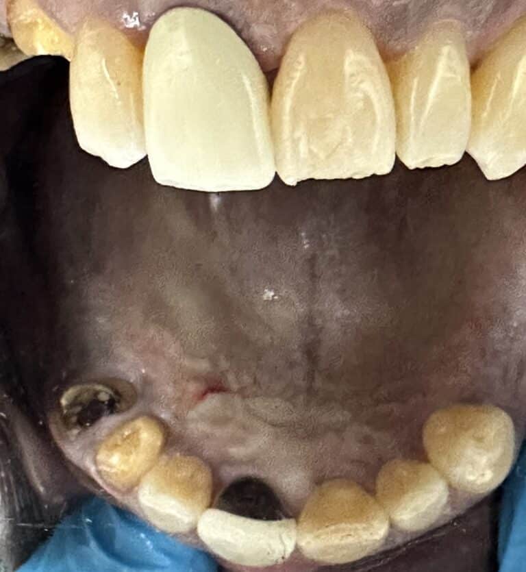 Before Image: Extraction of Upper Teeth with Immediate Placement of Implants for an “All-on-6” Full-Arch Fixed Implant Prosthesis - front