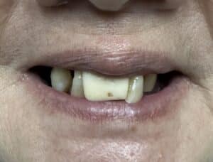 Before Image: Full Mouth Oral Implant Prostheses