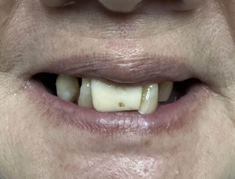 Before Image: Full Mouth Oral Implant Prostheses - front