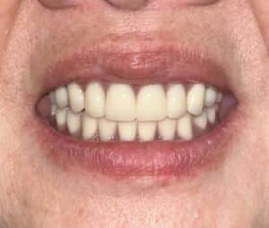 After Image: Full Mouth Oral Implant Prostheses