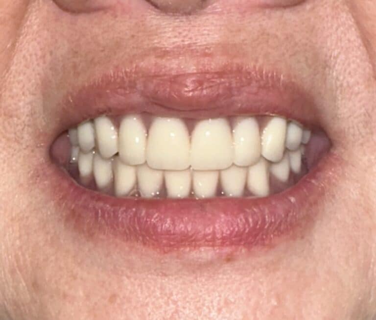 After Image: Full Mouth Oral Implant Prostheses - front