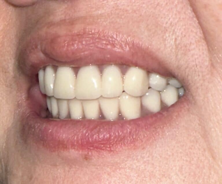 After Image: Full Mouth Oral Implant Prostheses - left-front-oblique