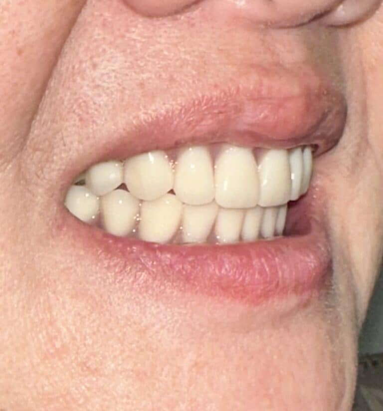 After Image: Full Mouth Oral Implant Prostheses - right-front-oblique