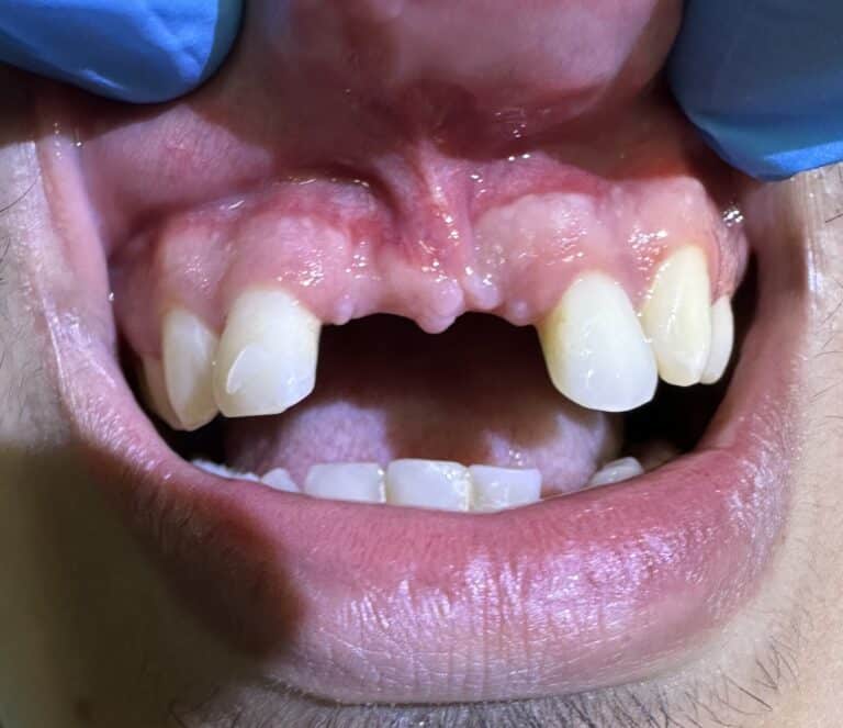 Before Image: Autogenous Bone Harvesting and Bone Transplantation to the Anterior Region of the Upper Arch with Placement of 4 Implants - front