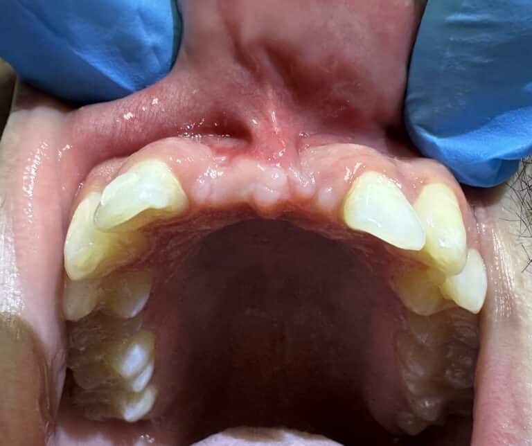 Before Image: Autogenous Bone Harvesting and Bone Transplantation to the Anterior Region of the Upper Arch with Placement of 4 Implants - front