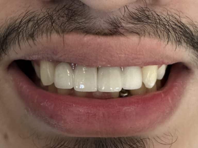 After Image: Autogenous Bone Harvesting and Bone Transplantation to the Anterior Region of the Upper Arch with Placement of 4 Implants - front