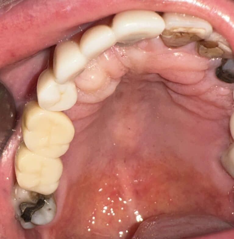 After Image: Autogenous Bone Block Grafting / Transplantation from Jaw and Ridge Splitting Procedure & Expansion with 5 Dental Implant Placements - front