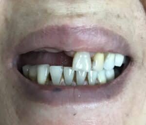 Before Image: Autogenous Bone Block Grafting / Transplantation from Jaw and Ridge Splitting Procedure & Expansion with 5 Dental Implant Placements