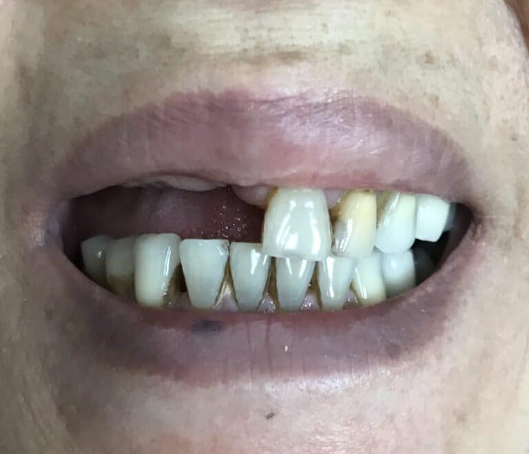 Before Image: Autogenous Bone Block Grafting / Transplantation from Jaw and Ridge Splitting Procedure & Expansion with 5 Dental Implant Placements - front