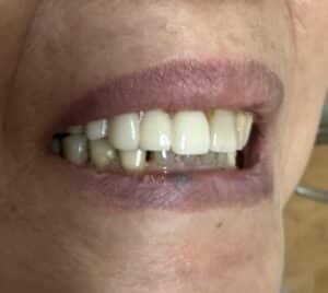 After Image: Autogenous Bone Block Grafting / Transplantation from Jaw and Ridge Splitting Procedure & Expansion with 5 Dental Implant Placements