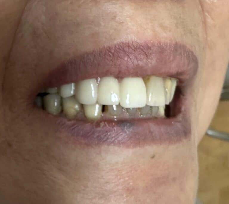 After Image: Autogenous Bone Block Grafting / Transplantation from Jaw and Ridge Splitting Procedure & Expansion with 5 Dental Implant Placements - front