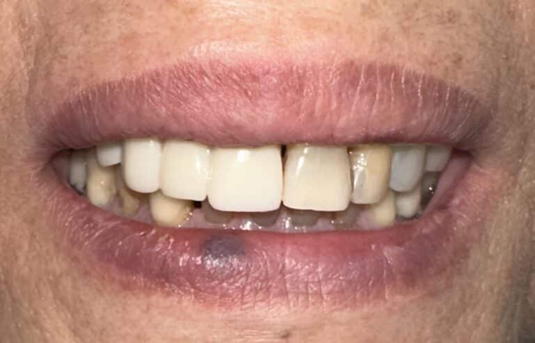After Image: Autogenous Bone Block Grafting / Transplantation from Jaw and Ridge Splitting Procedure & Expansion with 5 Dental Implant Placements - front