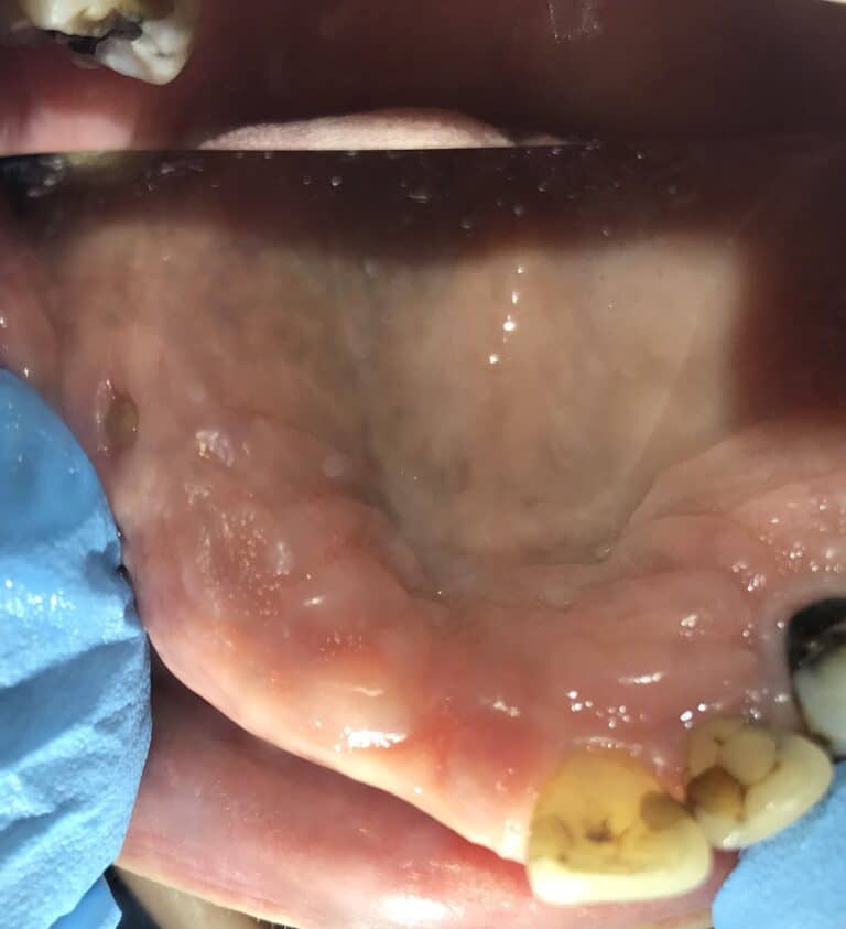 Before Image: Autogenous Bone Block Grafting / Transplantation from Jaw and Ridge Splitting Procedure & Expansion with 5 Dental Implant Placements - front