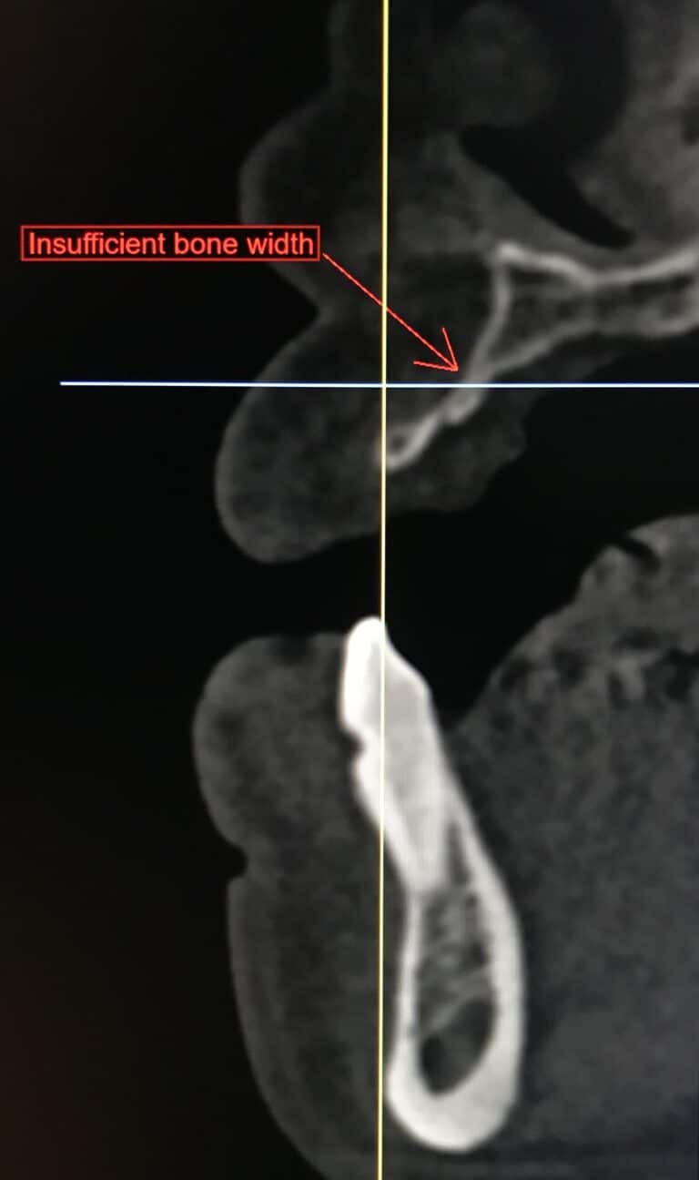 Before Image: Autogenous Bone Block Grafting / Transplantation from Jaw and Ridge Splitting Procedure & Expansion with 5 Dental Implant Placements - front