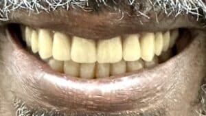 After Image: Upper Full-Arch 6-implant Removable Implant Overdenture