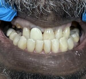 Before Image: Upper Full-Arch 6-implant Removable Implant Overdenture