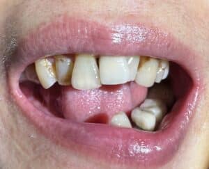 Before Image: Full-Arch Fixed Zirconia Implant Prosthesis