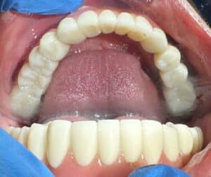 After Image: Full-Arch Fixed Zirconia Implant Prosthesis