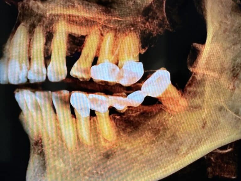 Before Image: Autogenous Bone Block Harvesting from Jaw and into Deficient Area needing 2 Teeth Extractions and 4 Dental Implant Placements - front