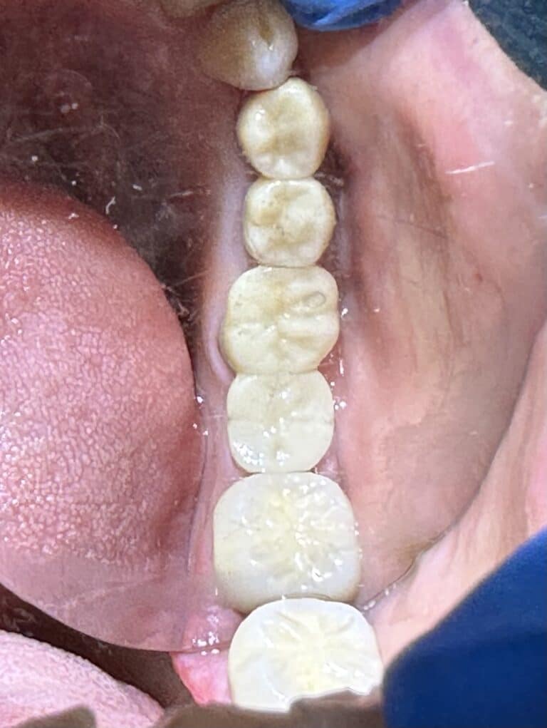 After Image: Autogenous Bone Block Harvesting from Jaw and into Deficient Area needing 2 Teeth Extractions and 4 Dental Implant Placements - front