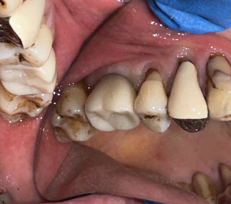 After Image: Sinus Lift via Lateral Window Approach and Bone Graft with Immediate Implant Placement - front