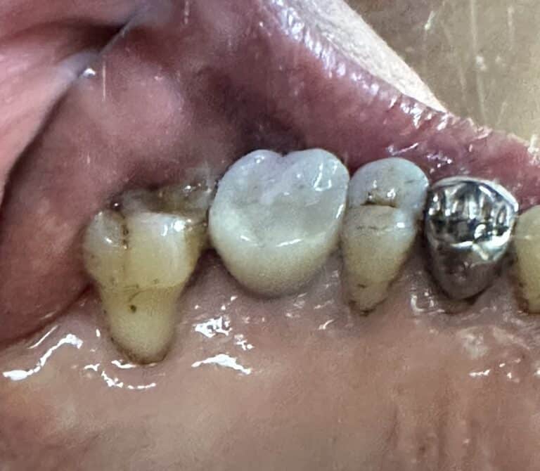 After Image: Sinus Lift via Lateral Window Approach and Bone Graft with Immediate Implant Placement -