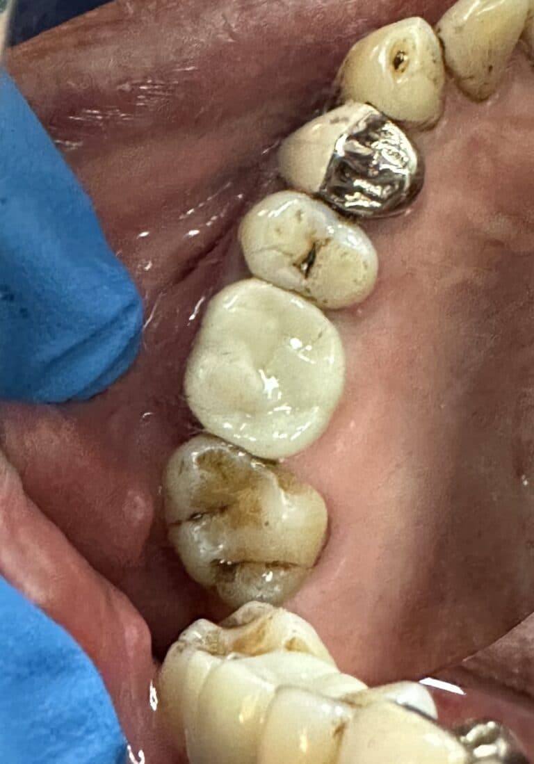 After Image: Sinus Lift via Lateral Window Approach and Bone Graft with Immediate Implant Placement -