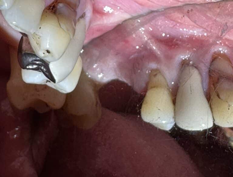 Before Image: Sinus Lift via Lateral Window Approach and Bone Graft with Immediate Implant Placement - front