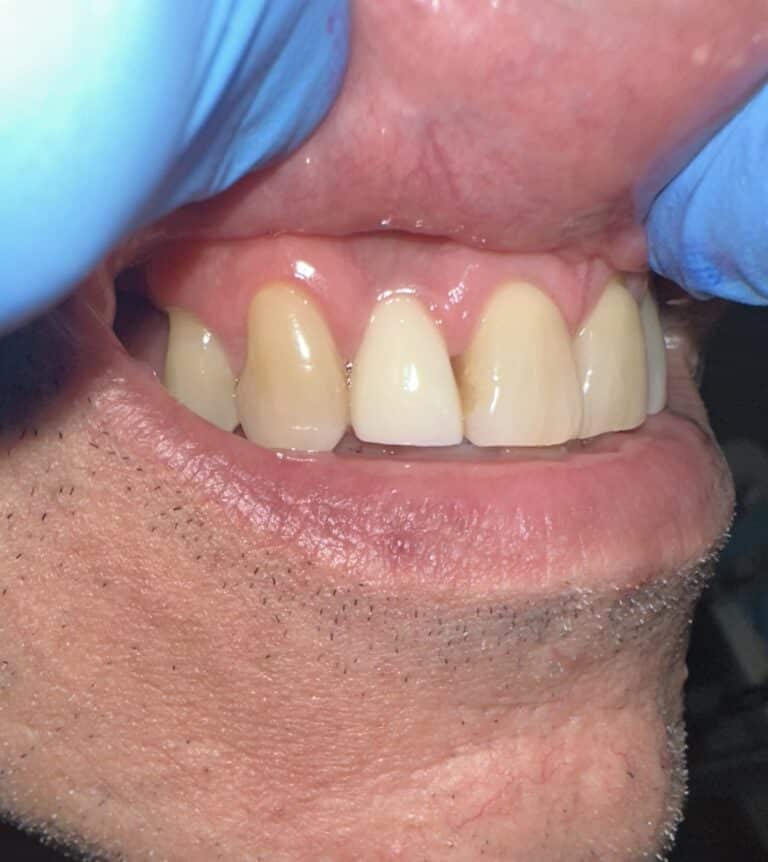 After Image: Accident resulting in Extraction of Tooth with an Immediate Placement of an Implant in the Aesthetic Zone - front