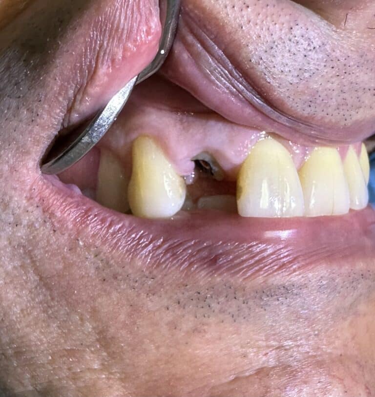 Before Image: Accident resulting in Extraction of Tooth with an Immediate Placement of an Implant in the Aesthetic Zone - front