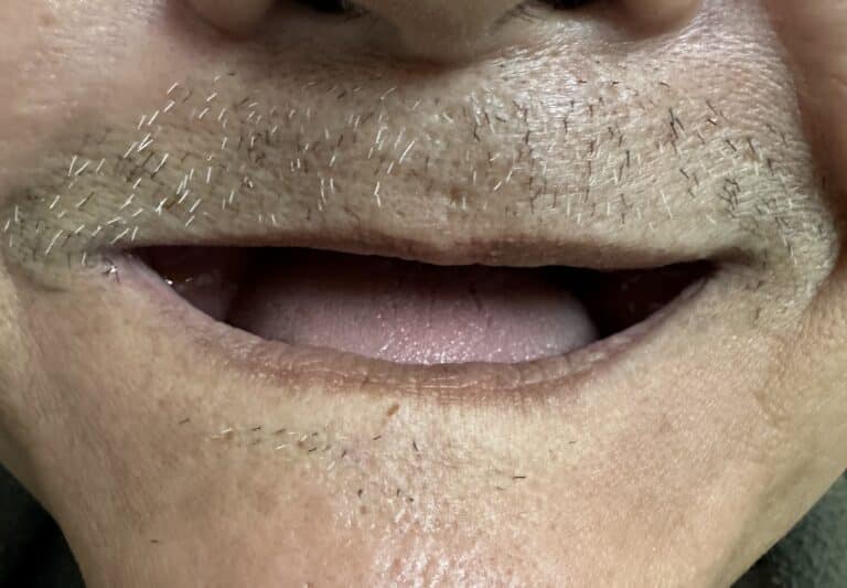 Before Image: Upper Full-Arch “All-0n-6” Implant Prosthesis - front