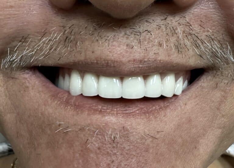 After Image: Upper Full-Arch “All-0n-6” Implant Prosthesis - front