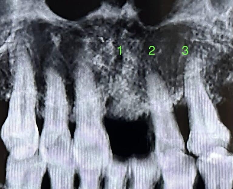 Before Image: 3 Dental Implants in the Anterior Region of the Upper Arch - front
