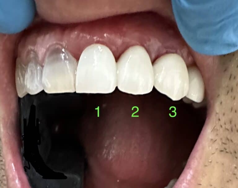 After Image: 3 Dental Implants in the Anterior Region of the Upper Arch - front