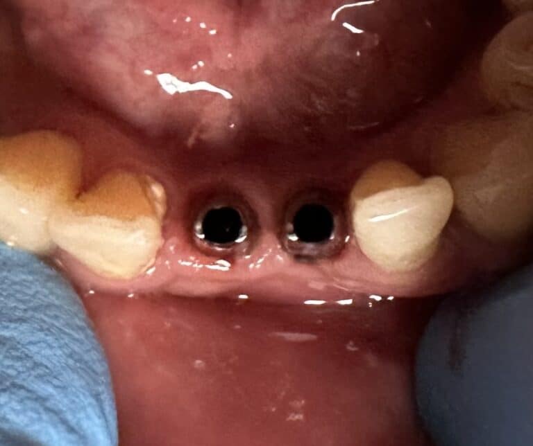 After Image: Immediate Placement of 2 Dental Implants after Extraction of Teeth in the Anterior Region of the Lower Jaw - front