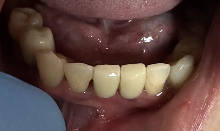 After Image: Immediate Placement of 2 Dental Implants after Extraction of Teeth in the Anterior Region of the Lower Jaw - front