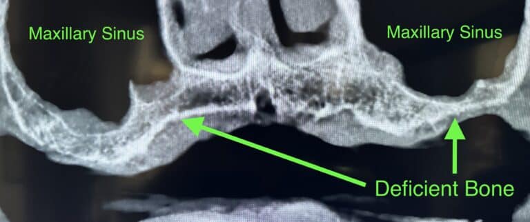 Before Image: Upper Full-Arch  Fixed 6 Implants Implant Prosthesis with Bilateral Sinus Augmentation (External Sinus Lift / Elevation) - front