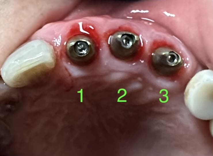 After Image: 3 Dental Implants in the Anterior Region of the Upper Arch - front