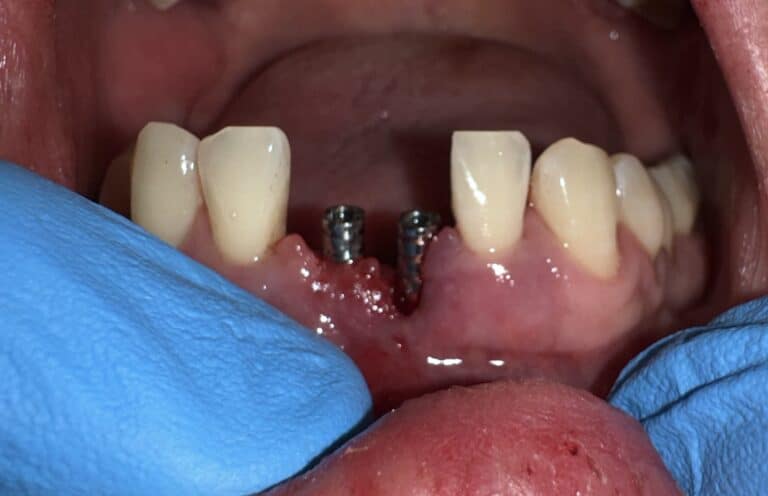 Before Image: Immediate Placement of 2 Dental Implants after Extraction of Teeth in the Anterior Region of the Lower Jaw - front