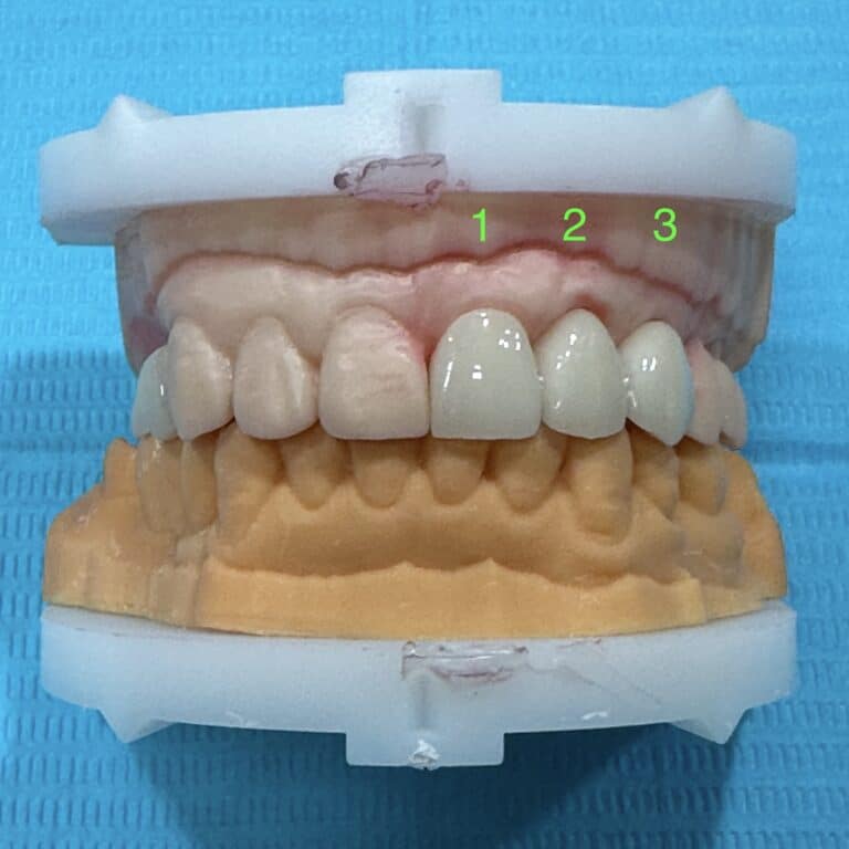 After Image: 3 Dental Implants in the Anterior Region of the Upper Arch - front
