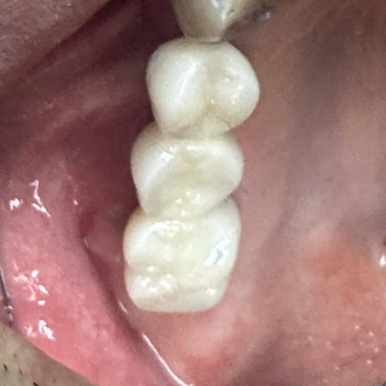 After Image: Sinus Augmentation via Lateral Window Approach with Placement of 3 Dental Implants - front
