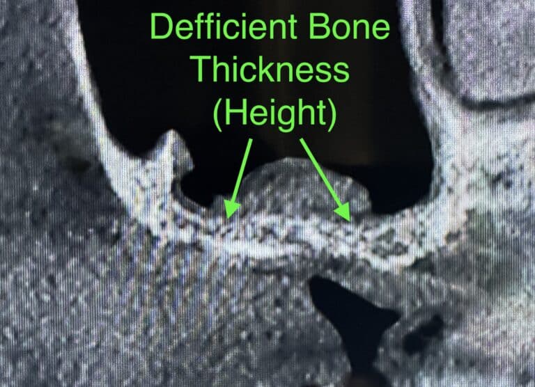 Before Image: Sinus Augmentation via Lateral Window Approach with Placement of 3 Dental Implants - front